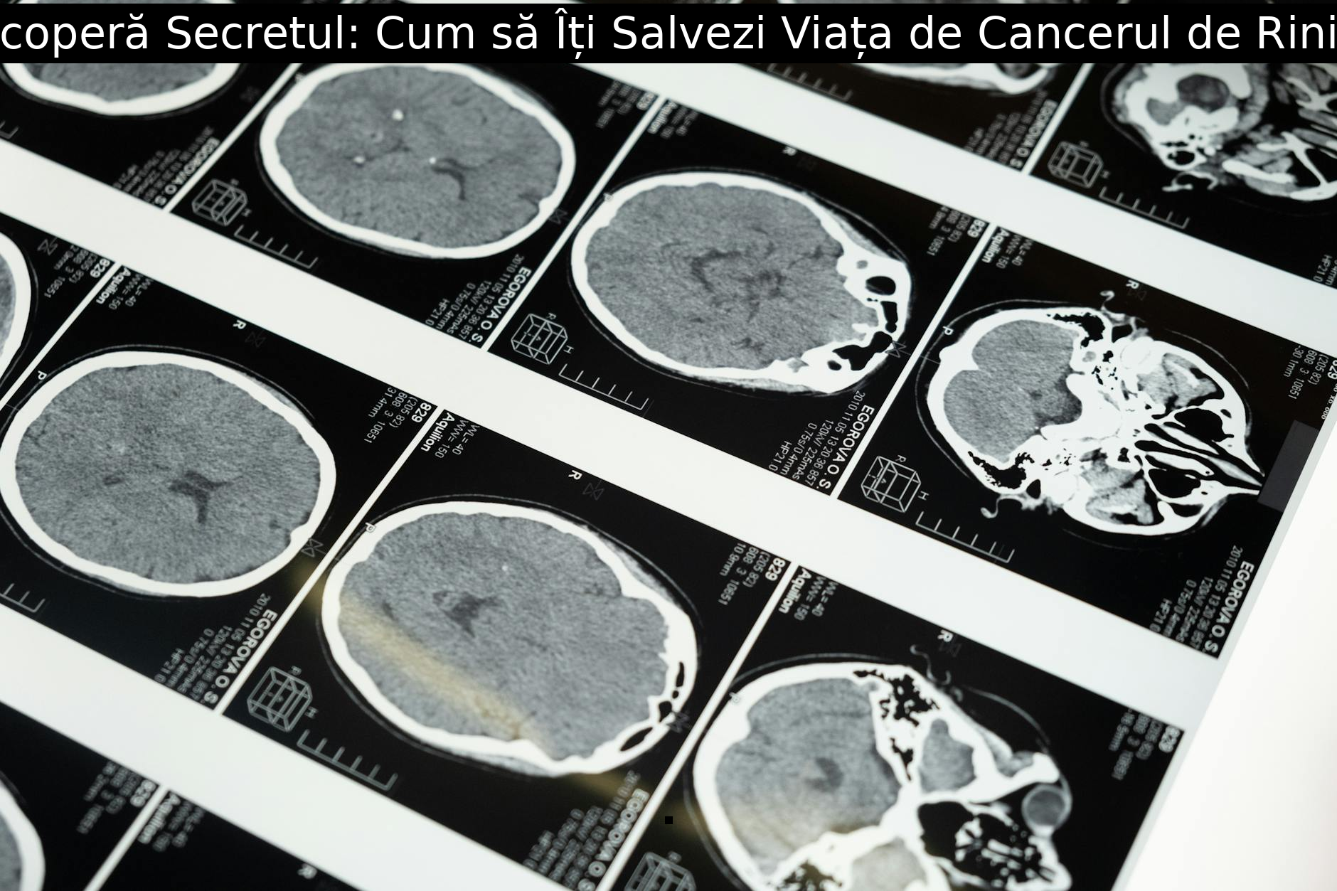 Descoperă Secretul: Cum să Îți Salvezi Viața de Cancerul de Rinichi!
