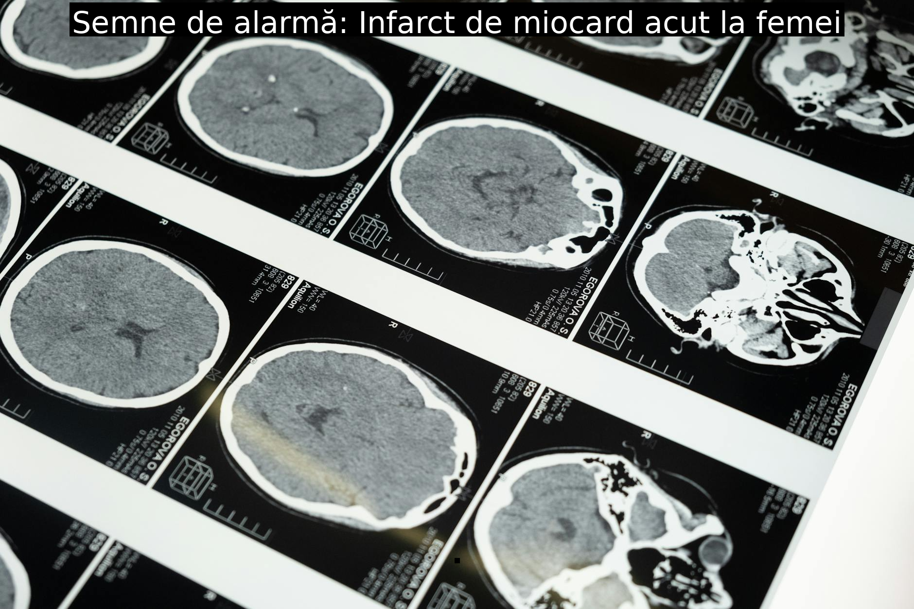 Semne de alarmă: Infarct de miocard acut la femei